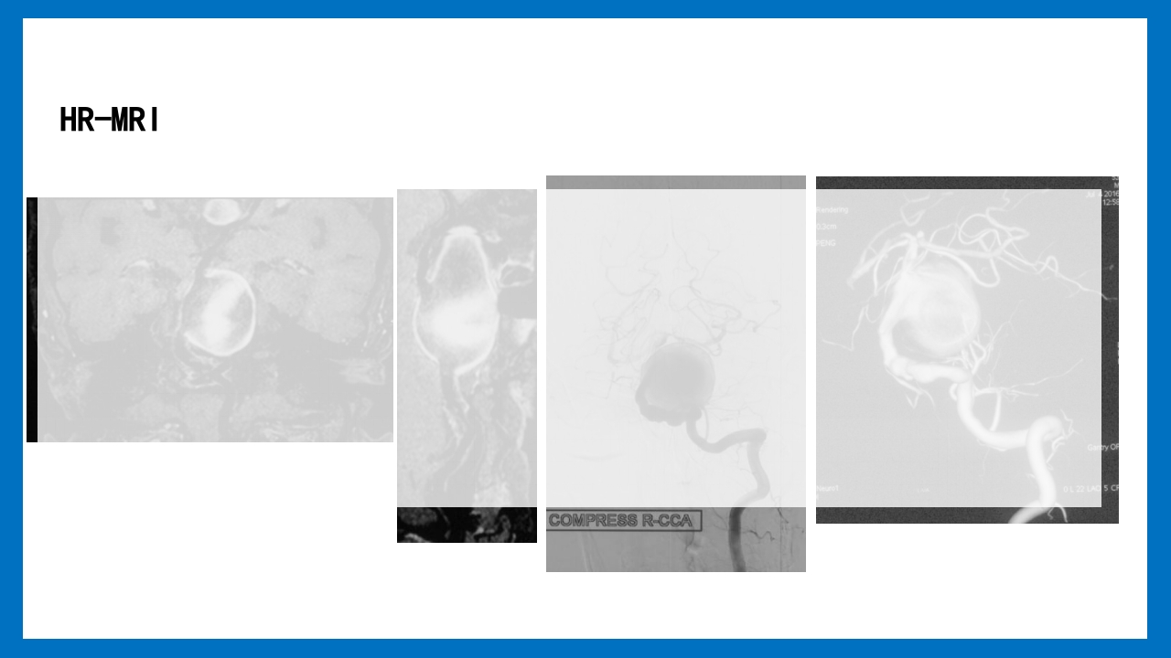 蛛网膜下腔出血的诊断和处理PPT课件36