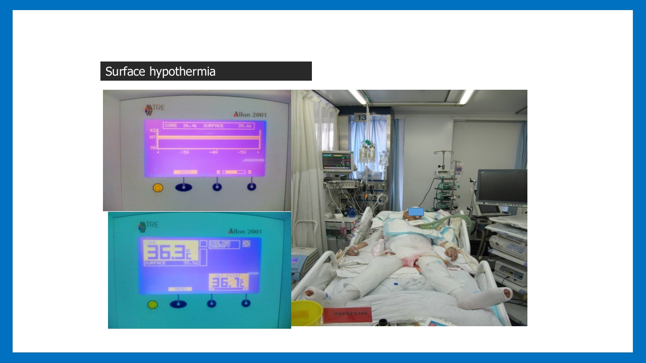 蛛网膜下腔出血的诊断和处理PPT课件61