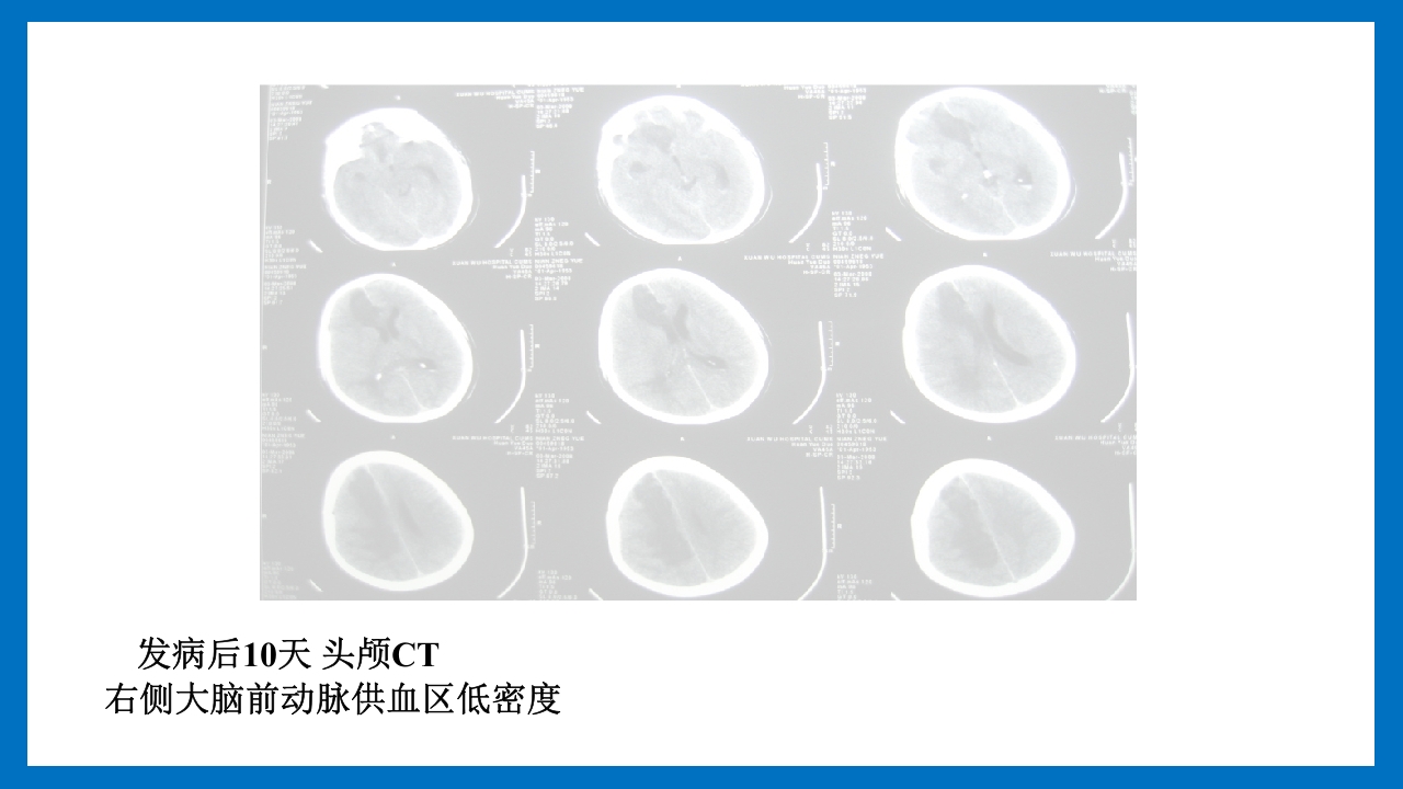 蛛网膜下腔出血的诊断和处理PPT课件72