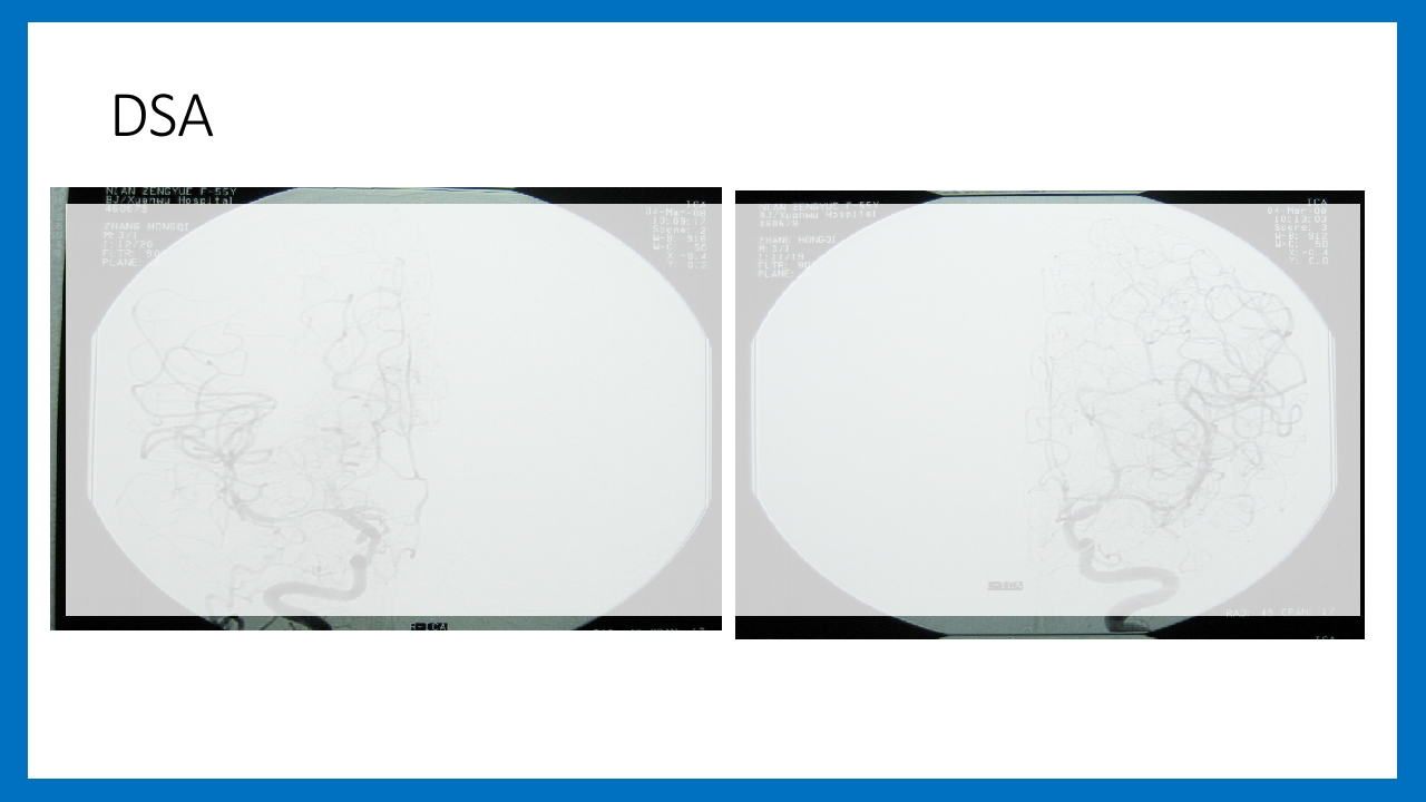 蛛网膜下腔出血的诊断和处理PPT课件73