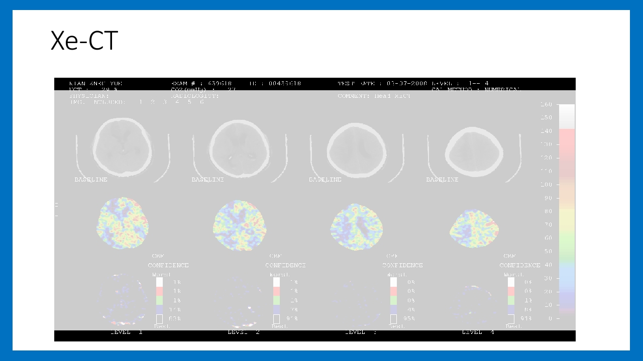 蛛网膜下腔出血的诊断和处理PPT课件74