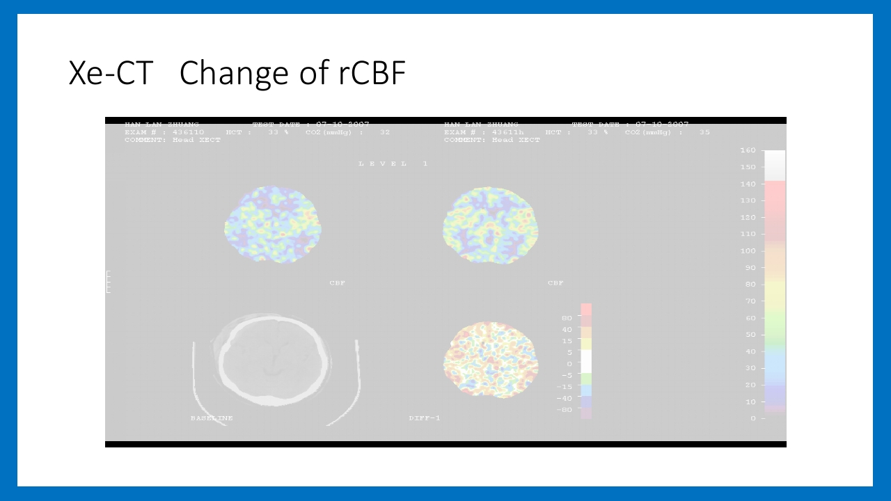 蛛网膜下腔出血的诊断和处理PPT课件75