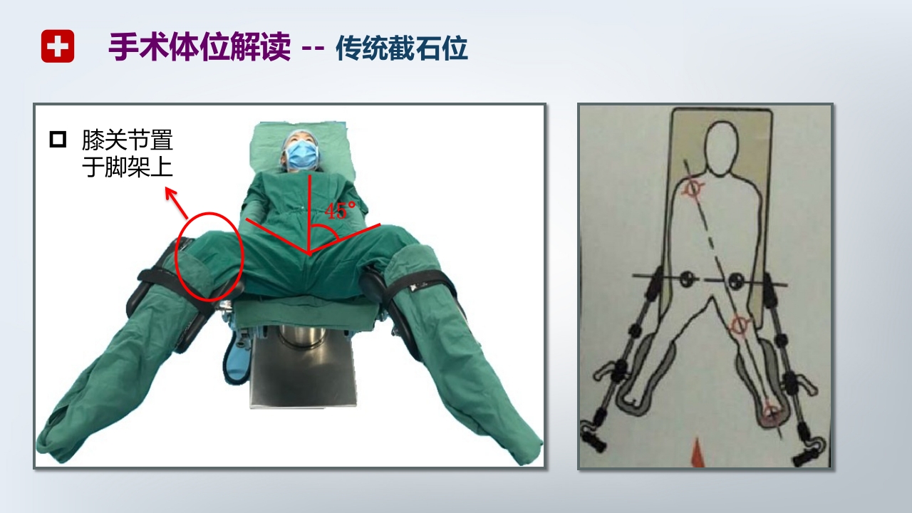 手术体位PPT课件21