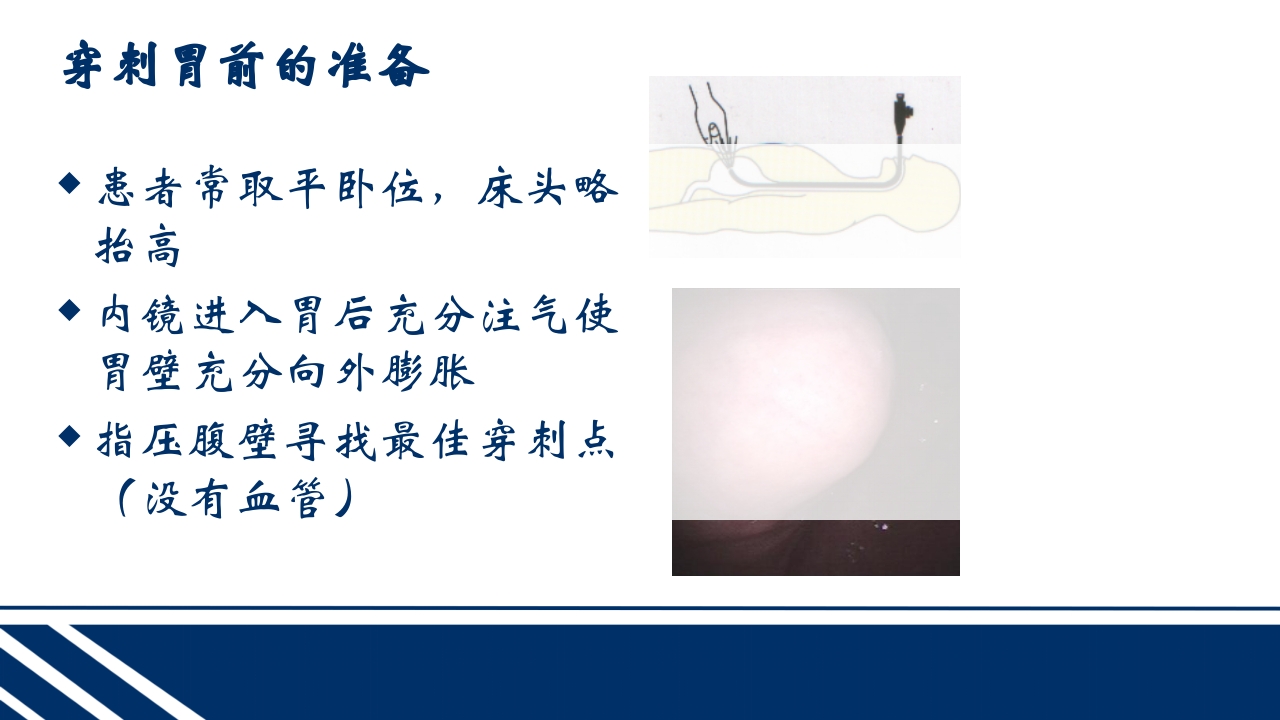 经皮内窥镜下胃空肠造瘘(PEGPEJ)的护理PPT课件15