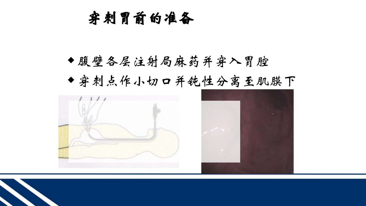 经皮内窥镜下胃空肠造瘘(PEGPEJ)的护理PPT课件16