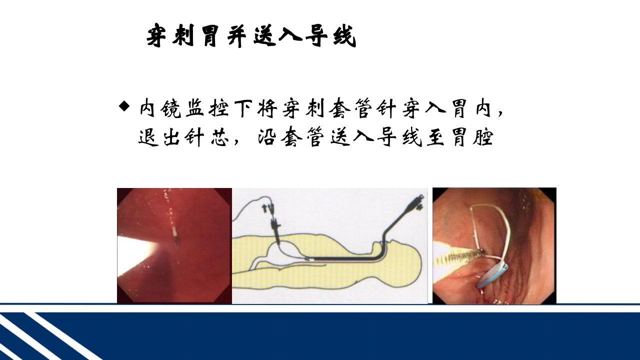 经皮内窥镜下胃空肠造瘘(PEGPEJ)的护理PPT课件17