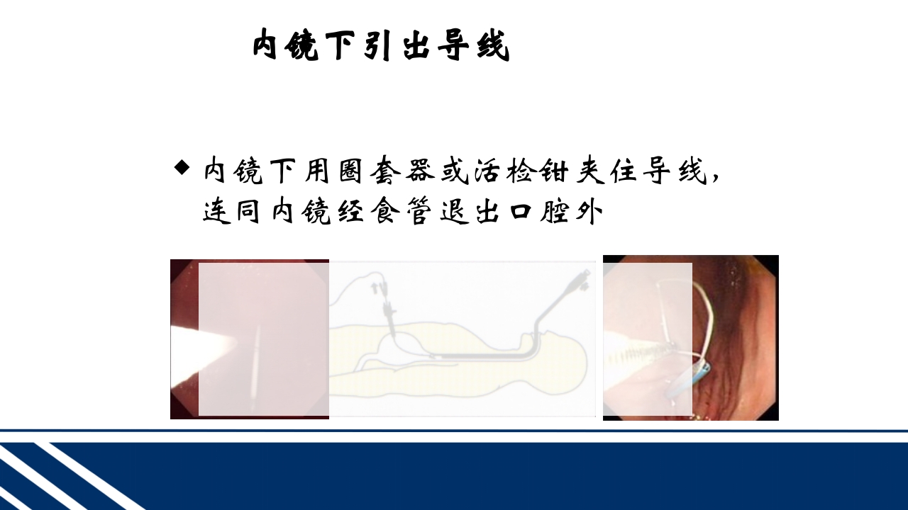 经皮内窥镜下胃空肠造瘘(PEGPEJ)的护理PPT课件18