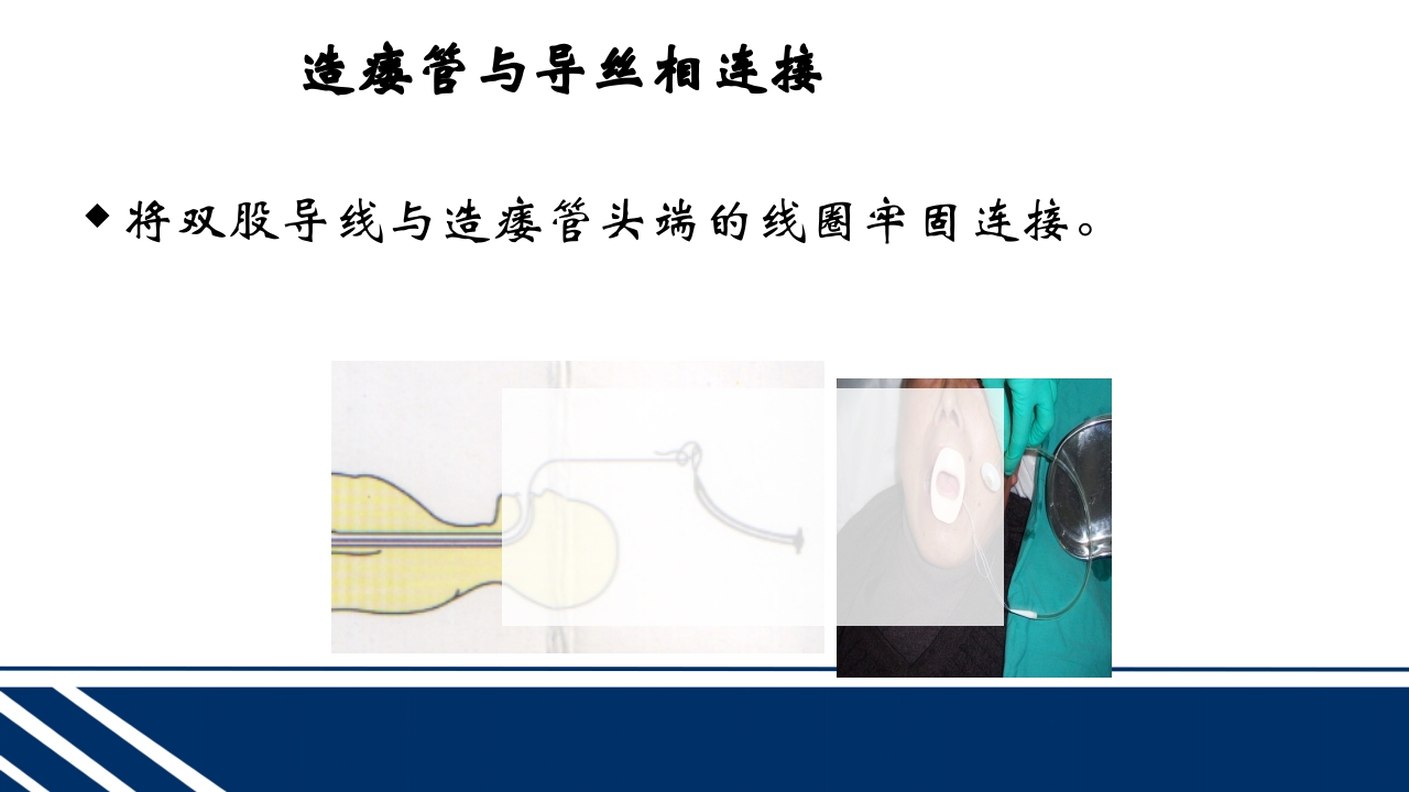 经皮内窥镜下胃空肠造瘘(PEGPEJ)的护理PPT课件19