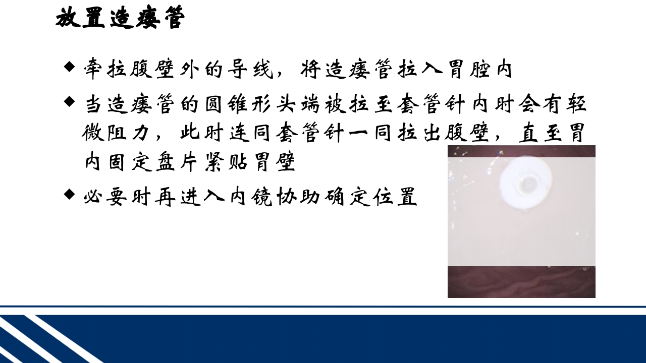 经皮内窥镜下胃空肠造瘘(PEGPEJ)的护理PPT课件20