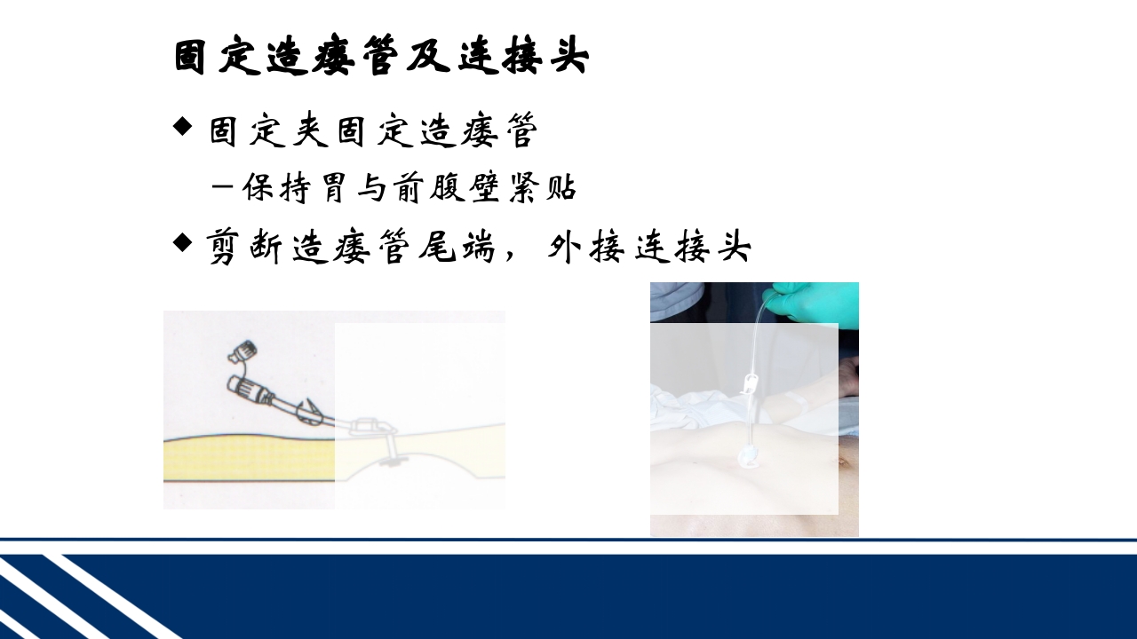 经皮内窥镜下胃空肠造瘘(PEGPEJ)的护理PPT课件21