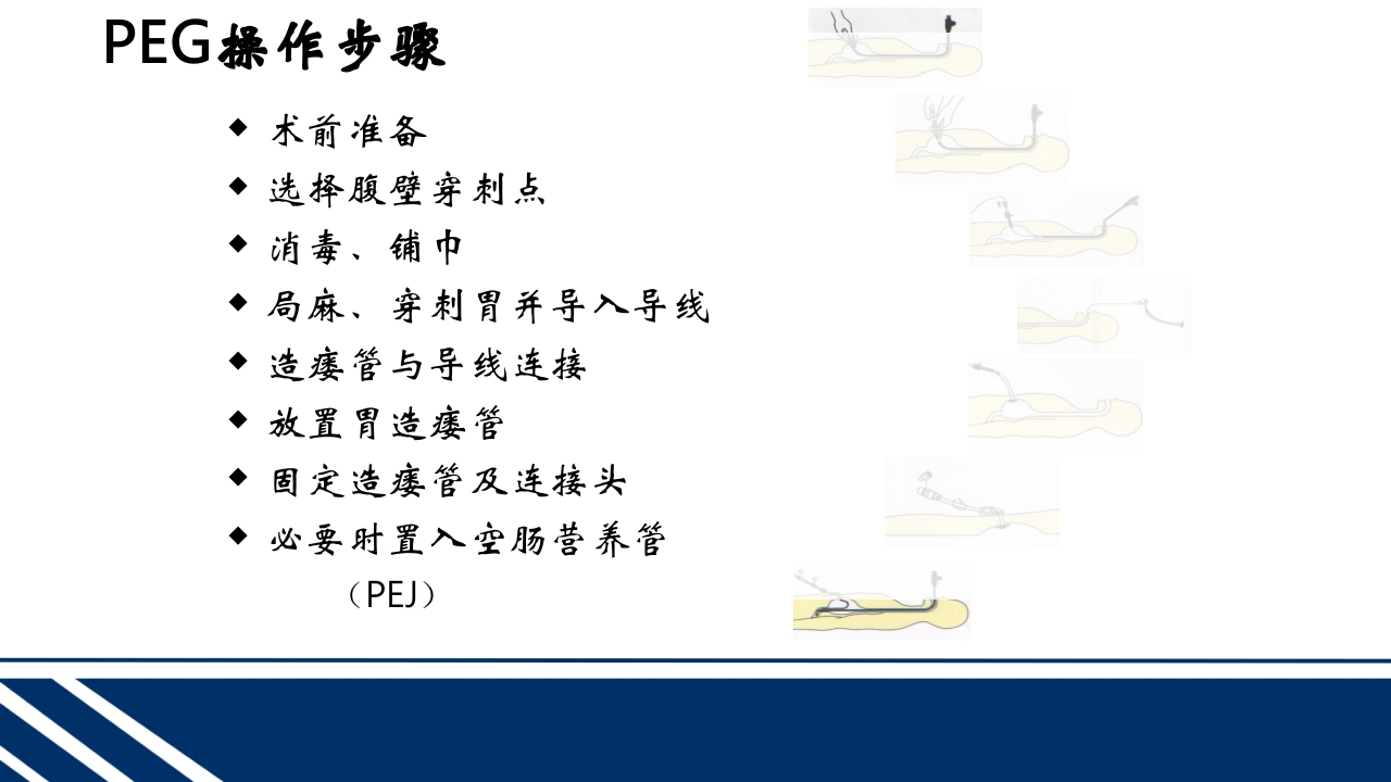 经皮内窥镜下胃空肠造瘘(PEGPEJ)的护理PPT课件22