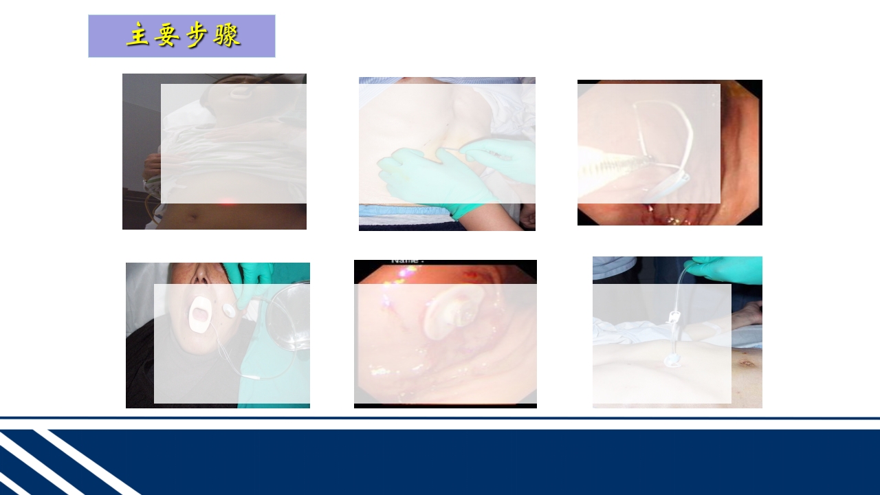 经皮内窥镜下胃空肠造瘘(PEGPEJ)的护理PPT课件23