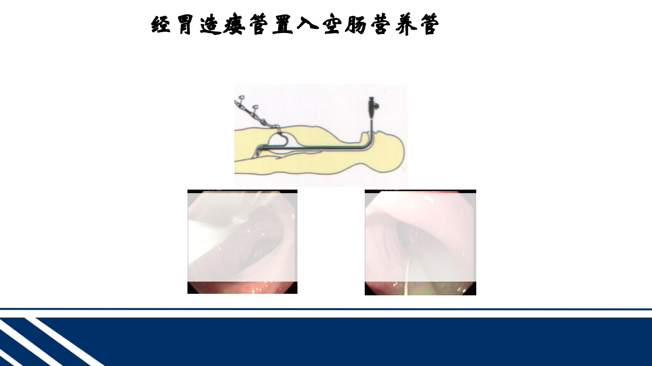 经皮内窥镜下胃空肠造瘘(PEGPEJ)的护理PPT课件25