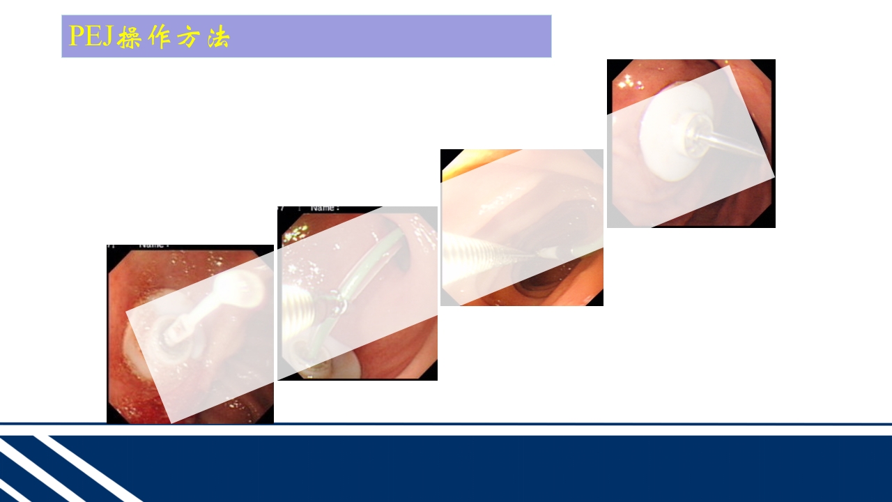 经皮内窥镜下胃空肠造瘘(PEGPEJ)的护理PPT课件26