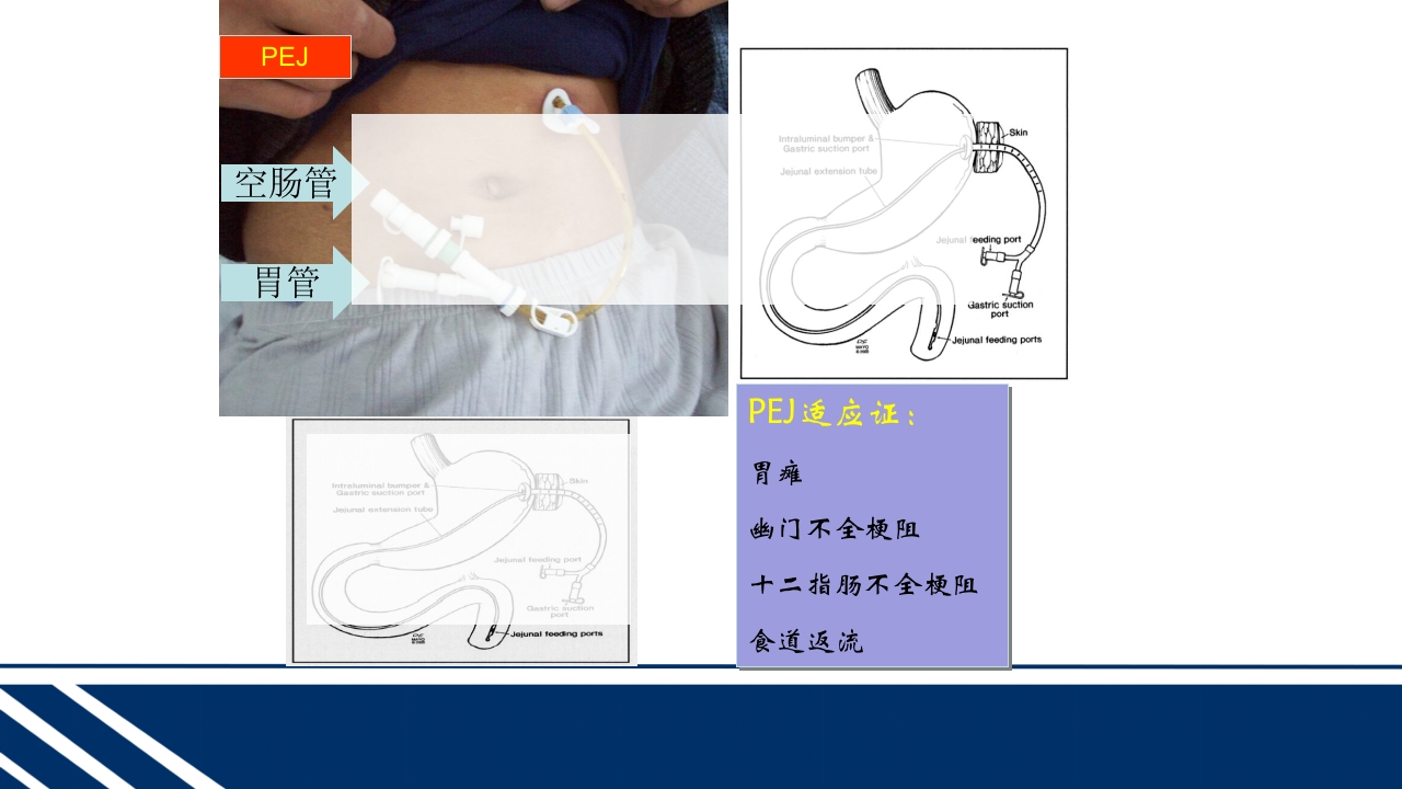经皮内窥镜下胃空肠造瘘(PEGPEJ)的护理PPT课件27