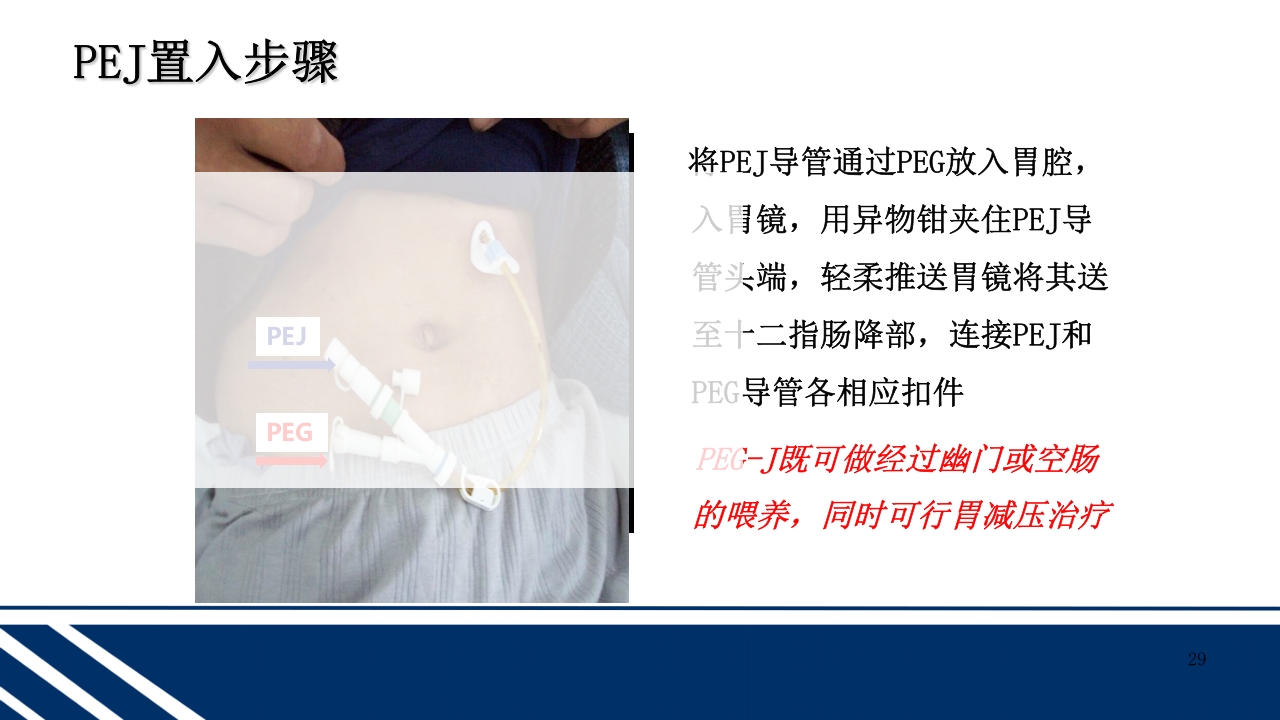 经皮内窥镜下胃空肠造瘘(PEGPEJ)的护理PPT课件29