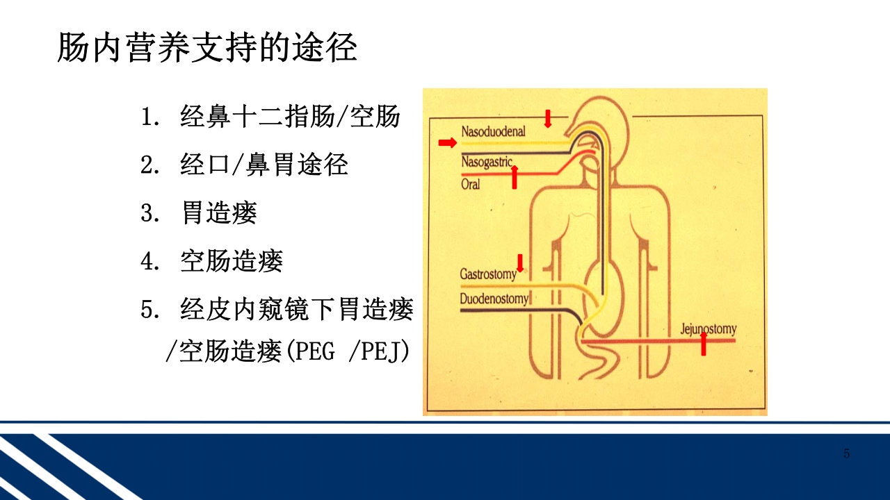 经皮内窥镜下胃空肠造瘘(PEGPEJ)的护理PPT课件5