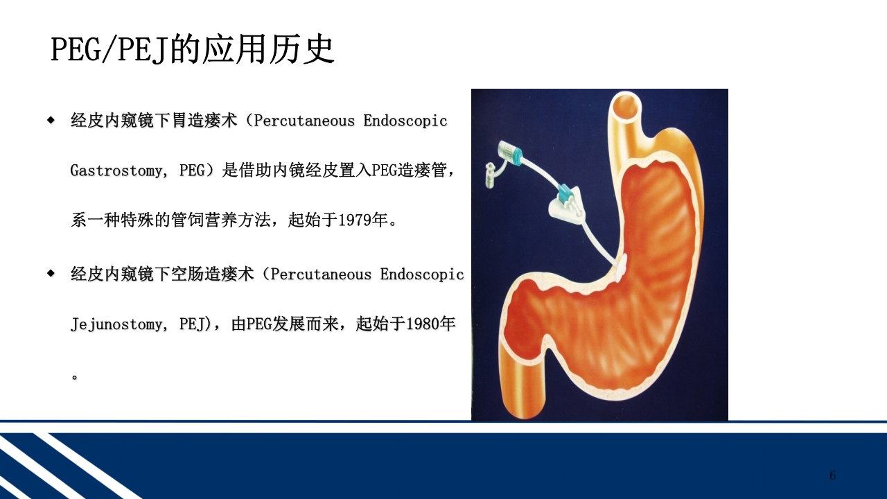 经皮内窥镜下胃空肠造瘘(PEGPEJ)的护理PPT课件6