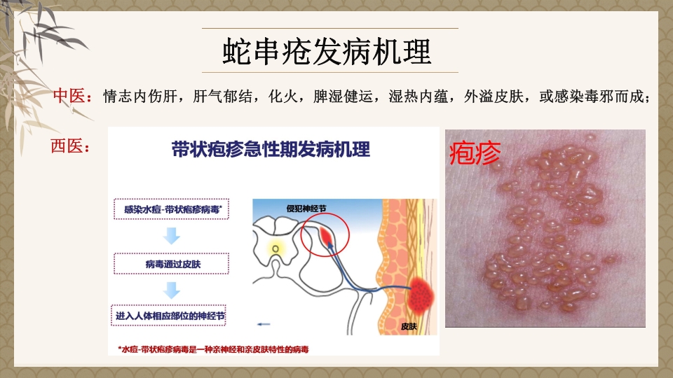 一例蛇串疮(带状疱疹)患者疼痛的个案护理PPT课件3