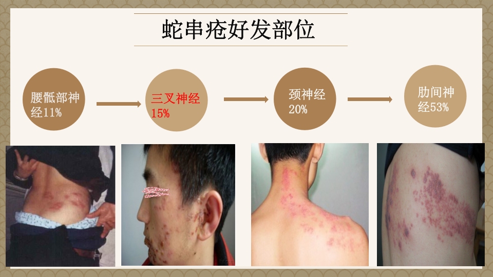 一例蛇串疮(带状疱疹)患者疼痛的个案护理PPT课件5