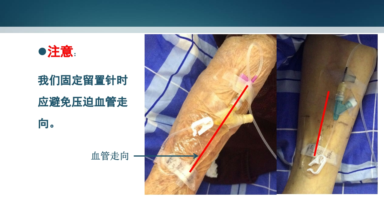 静脉留置针PPT课件13