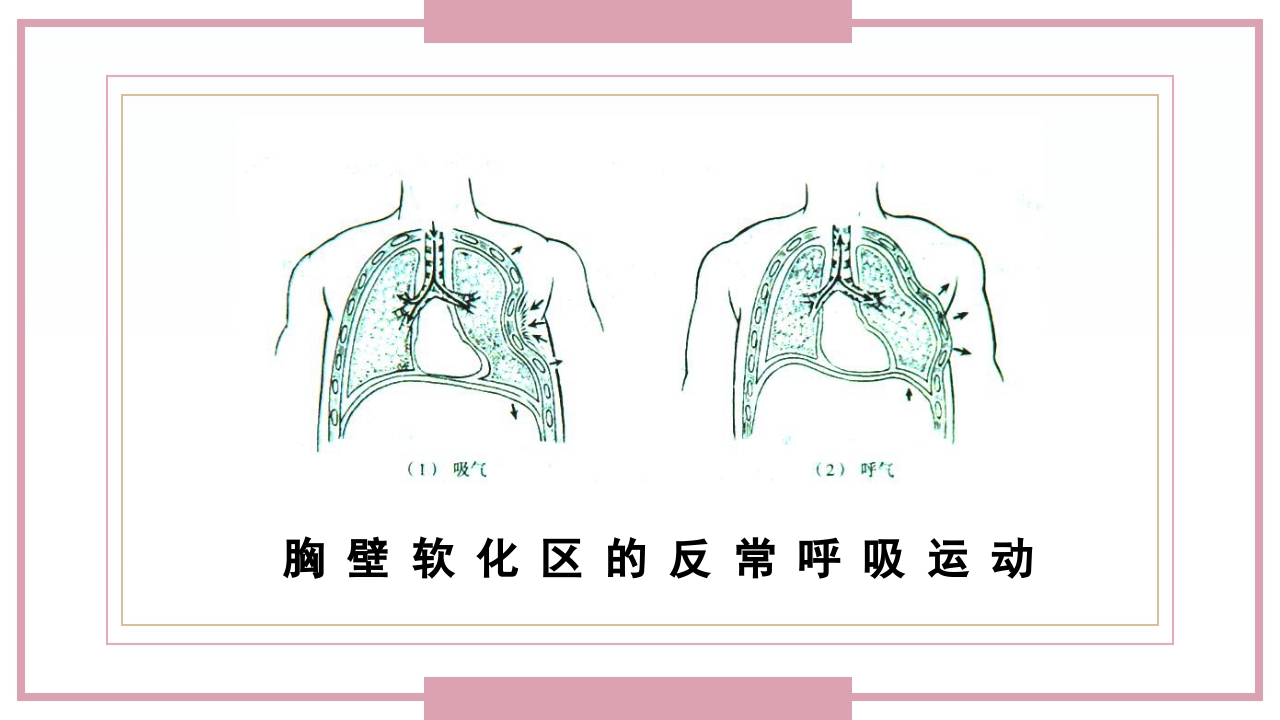 肋骨骨折病人的护理PPT课件15