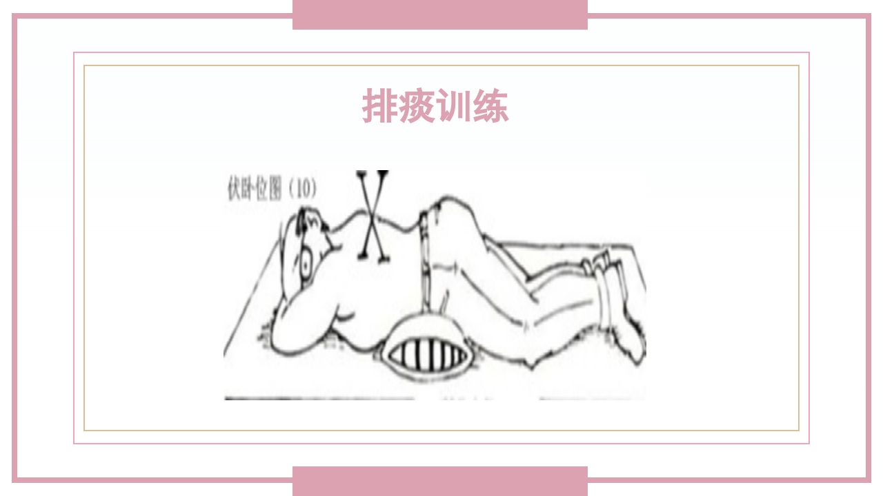 肋骨骨折病人的护理PPT课件30