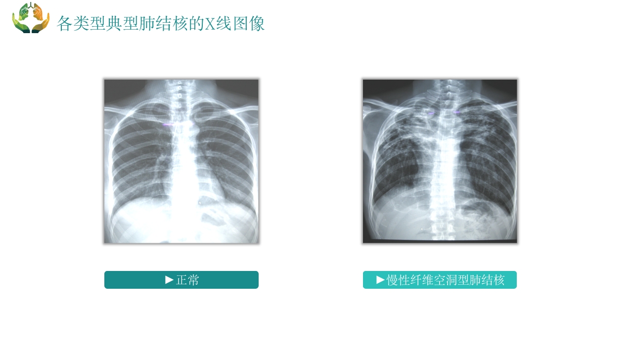 肺结核的护理PPT课件11
