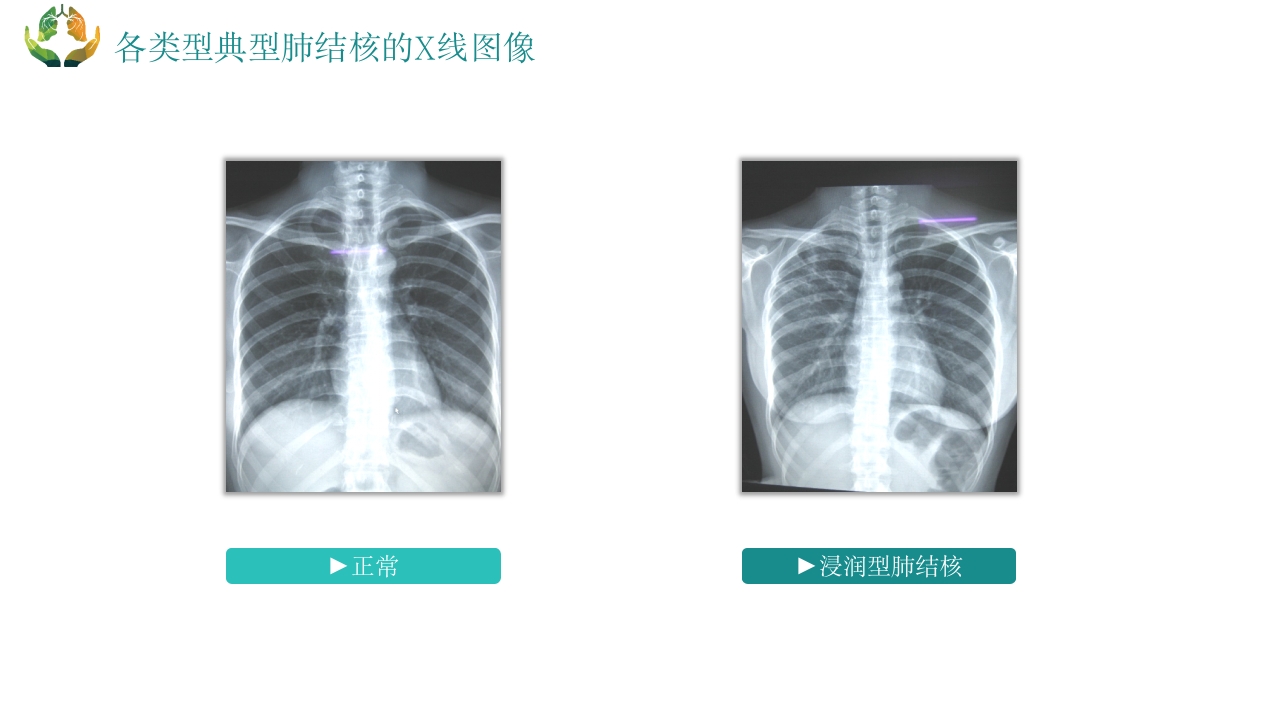 肺结核的护理PPT课件12