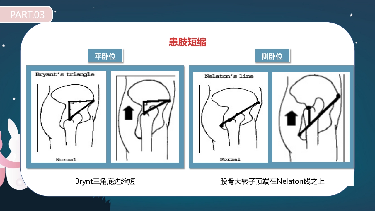 股骨颈骨折护理查房PPT课件18