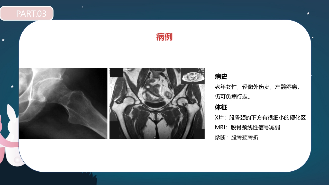 股骨颈骨折护理查房PPT课件20