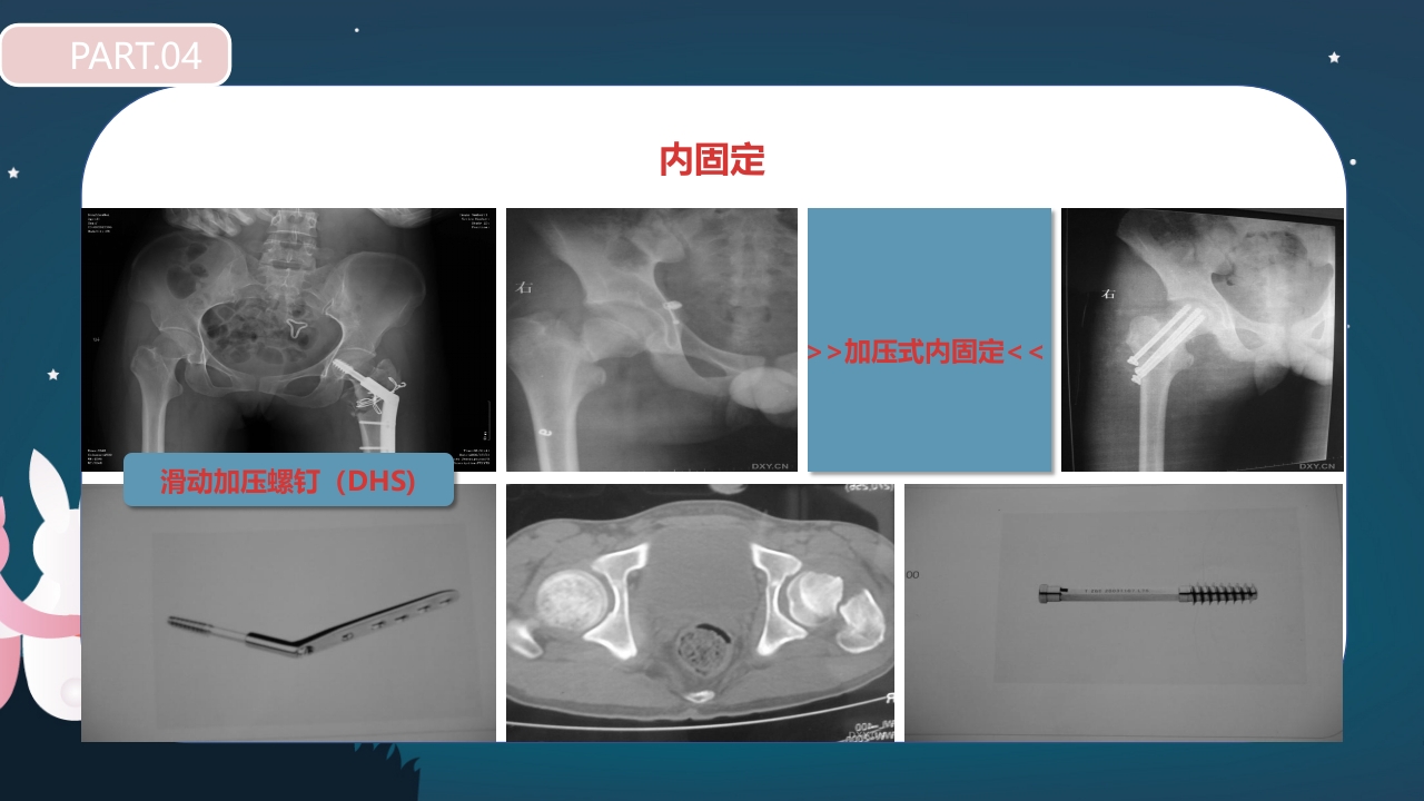 股骨颈骨折护理查房PPT课件29