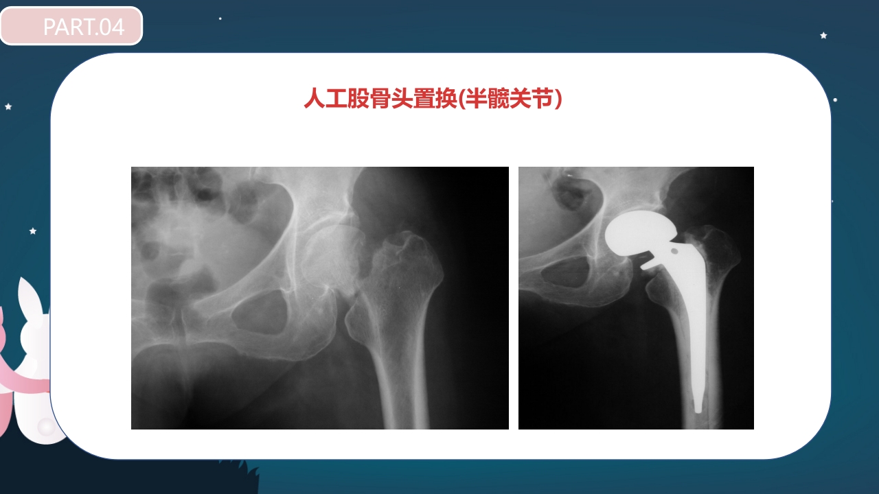 股骨颈骨折护理查房PPT课件32
