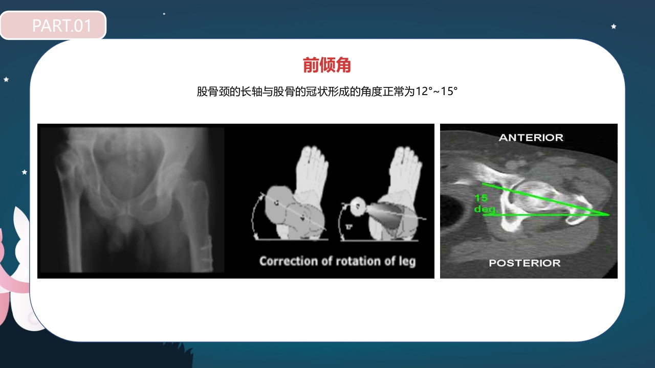 股骨颈骨折护理查房PPT课件8