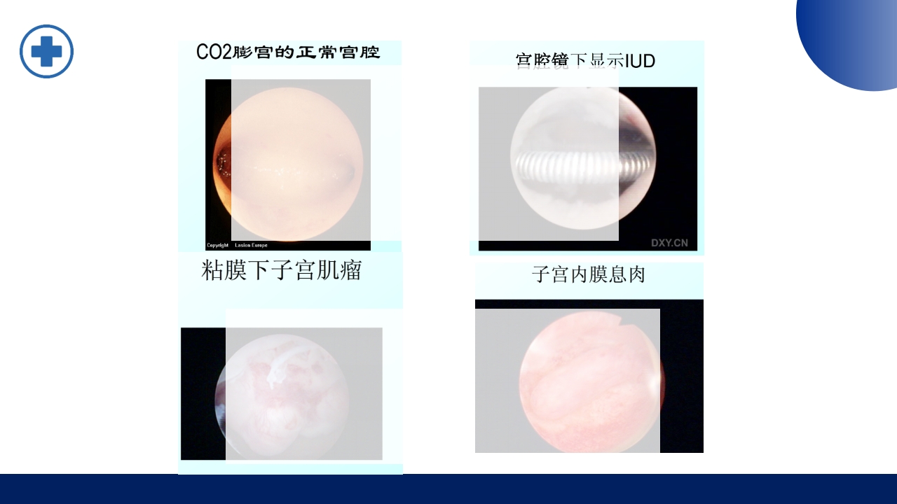 宫腔镜的适应症禁忌症及术中注意事项PPT课件11