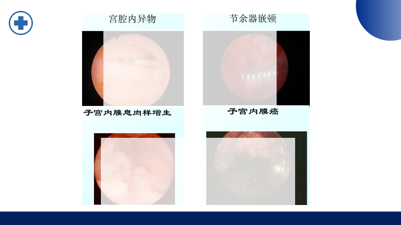 宫腔镜的适应症禁忌症及术中注意事项PPT课件12