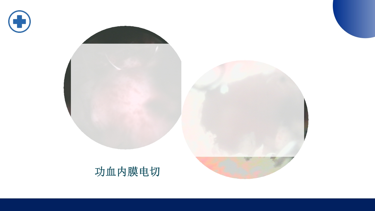 宫腔镜的适应症禁忌症及术中注意事项PPT课件27