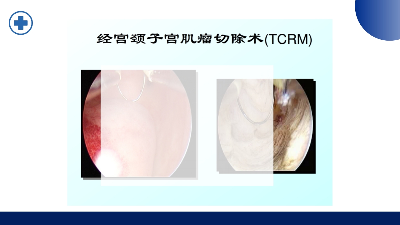 宫腔镜的适应症禁忌症及术中注意事项PPT课件33
