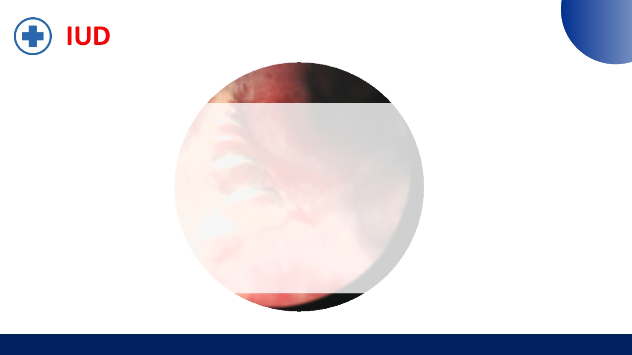 宫腔镜的适应症禁忌症及术中注意事项PPT课件37