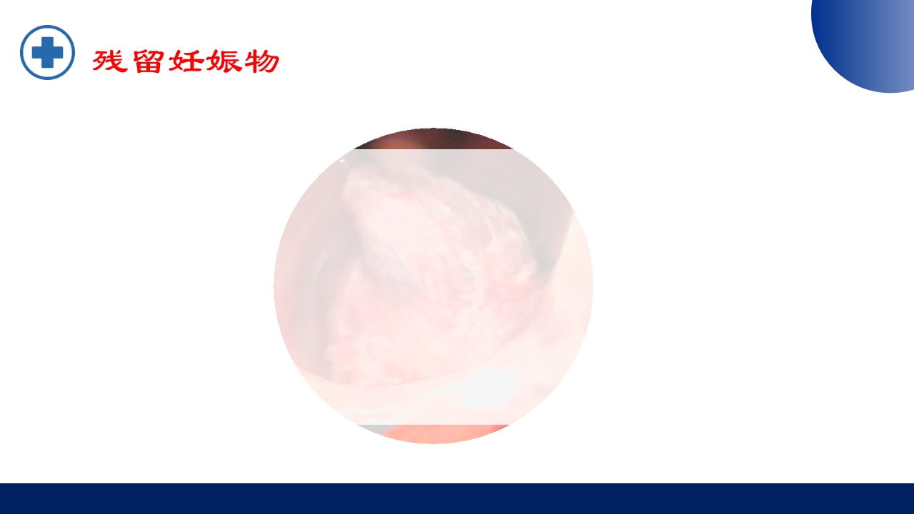 宫腔镜的适应症禁忌症及术中注意事项PPT课件38