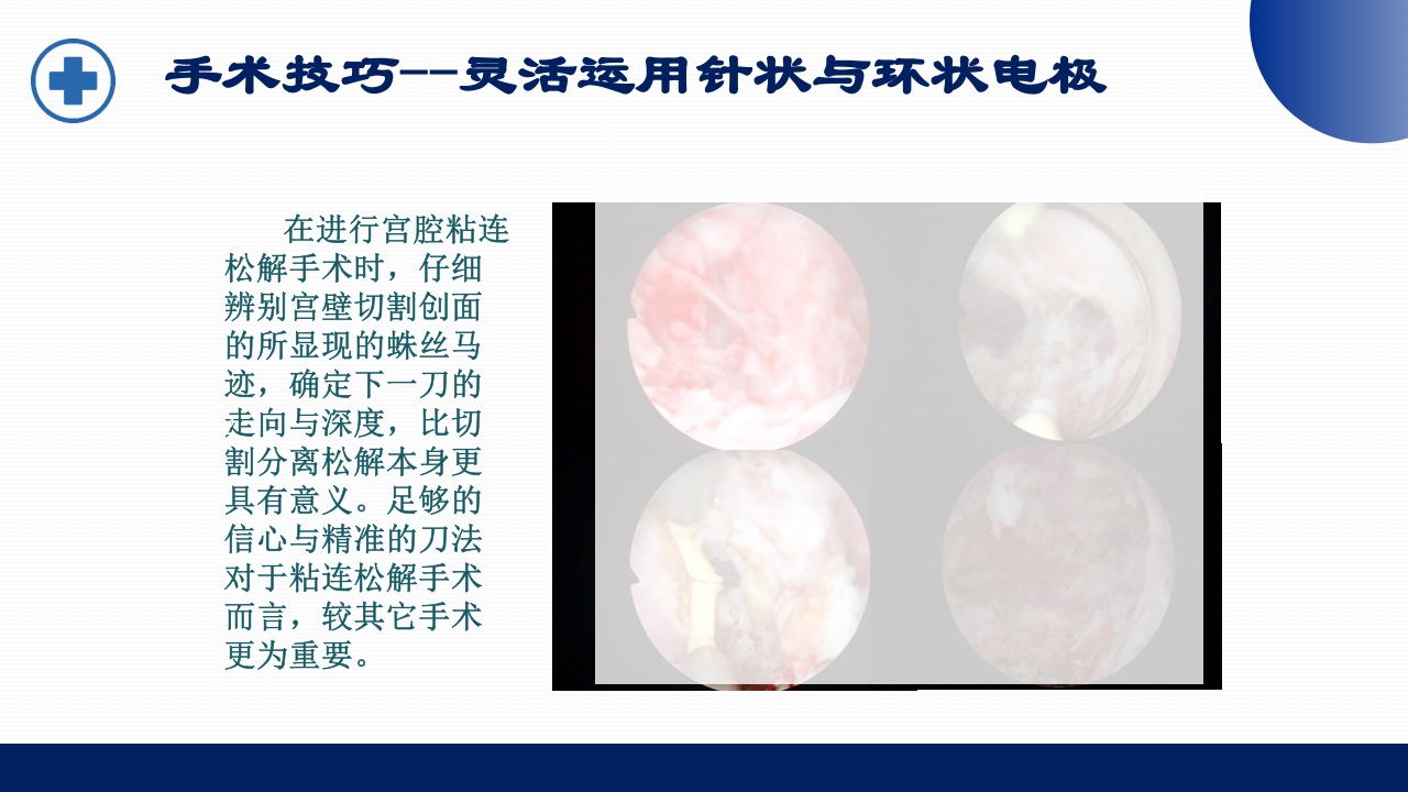 宫腔镜的适应症禁忌症及术中注意事项PPT课件43