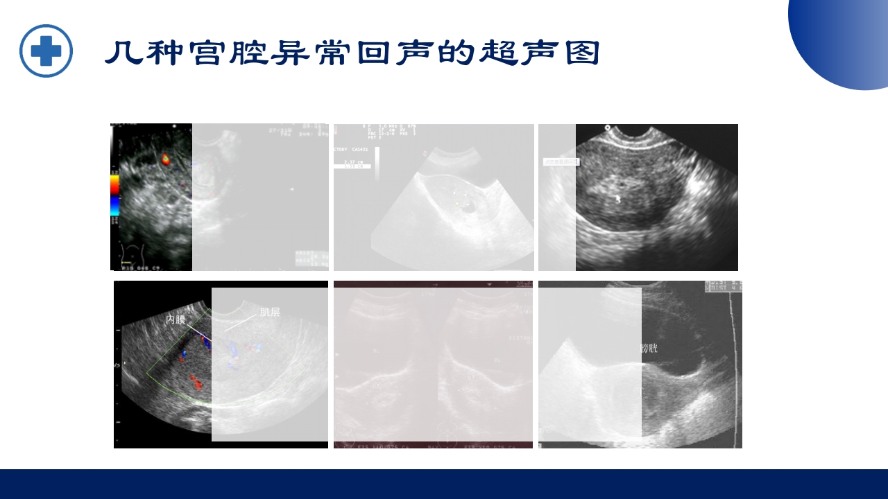 宫腔镜的适应症禁忌症及术中注意事项PPT课件7