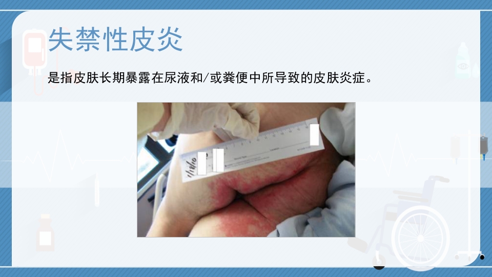 失禁性皮炎与压疮的区别医疗护理PPT课件4