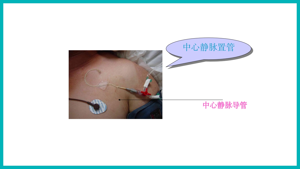 中心静脉压测量ppt8