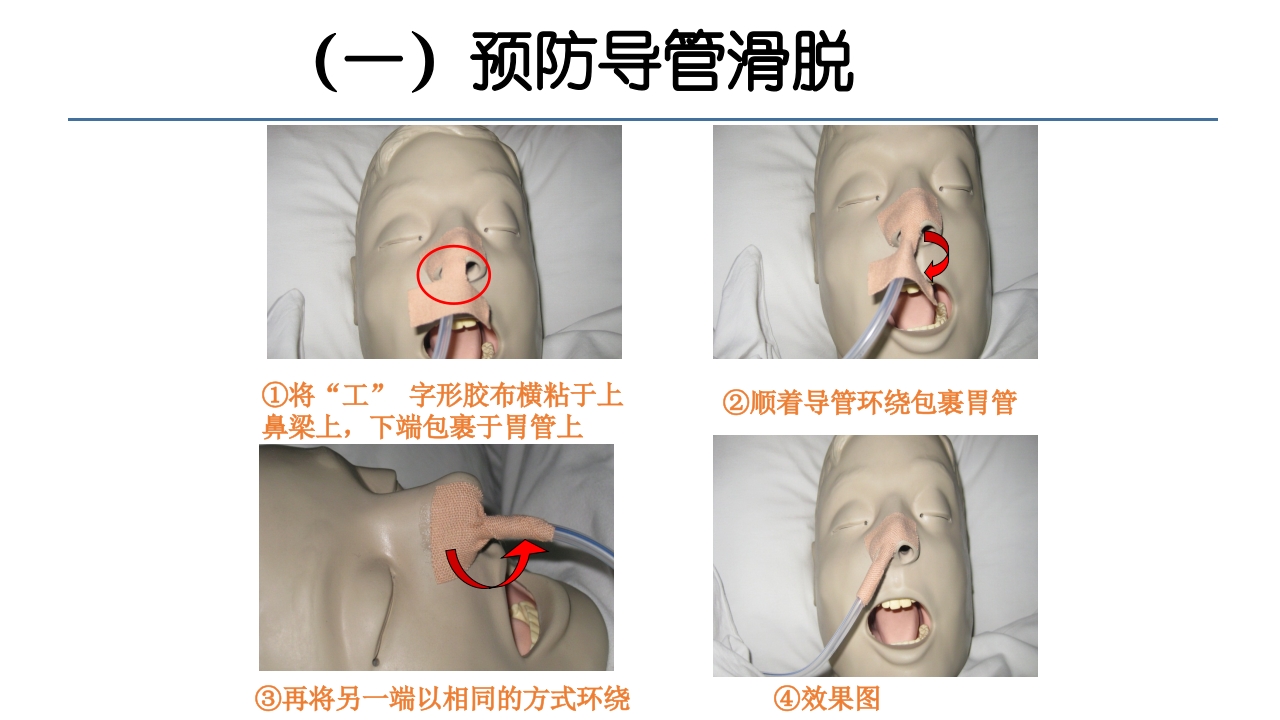 各类导管脱出的护理PPT课件4