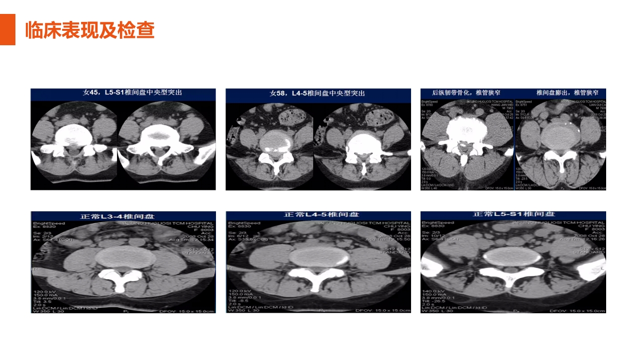 腰椎间盘突出症护理查房PPT课件20