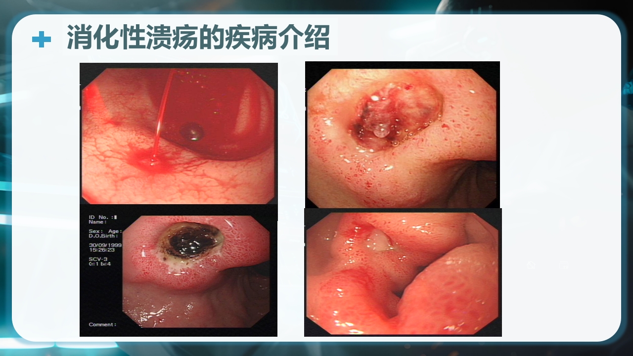 消化性溃疡的健康教育PPT课件12