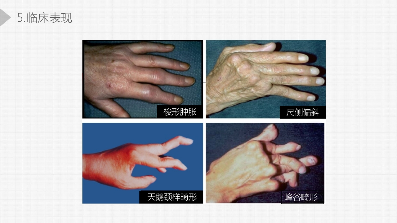 类风湿关节炎详细内容PPT课件12