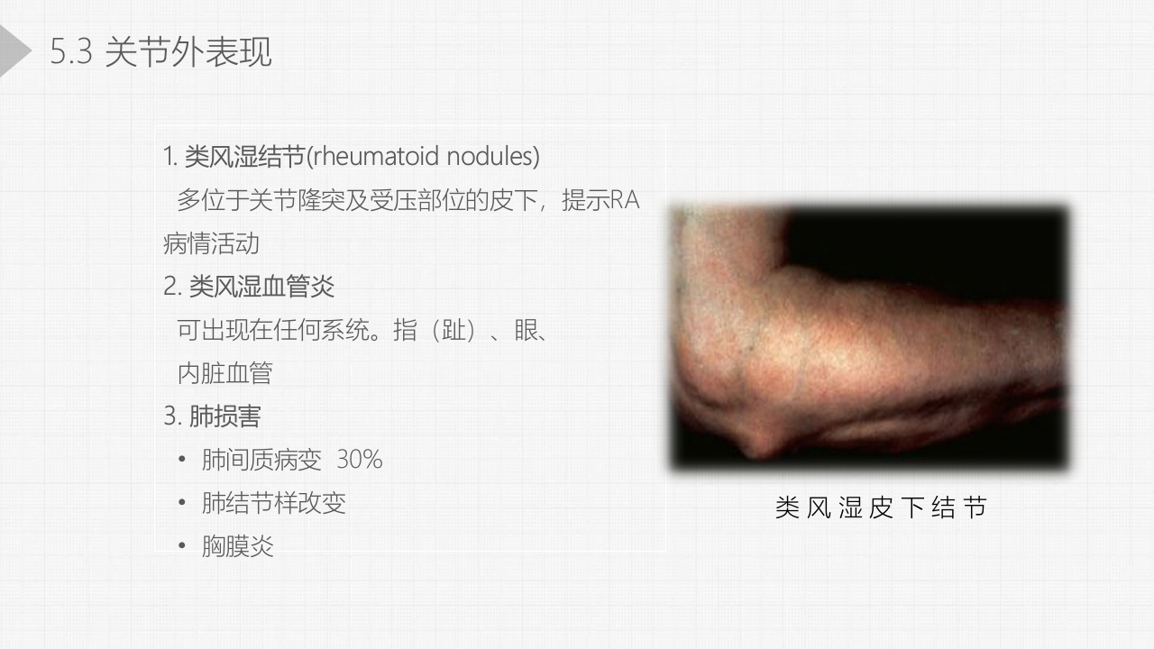 类风湿关节炎详细内容PPT课件15