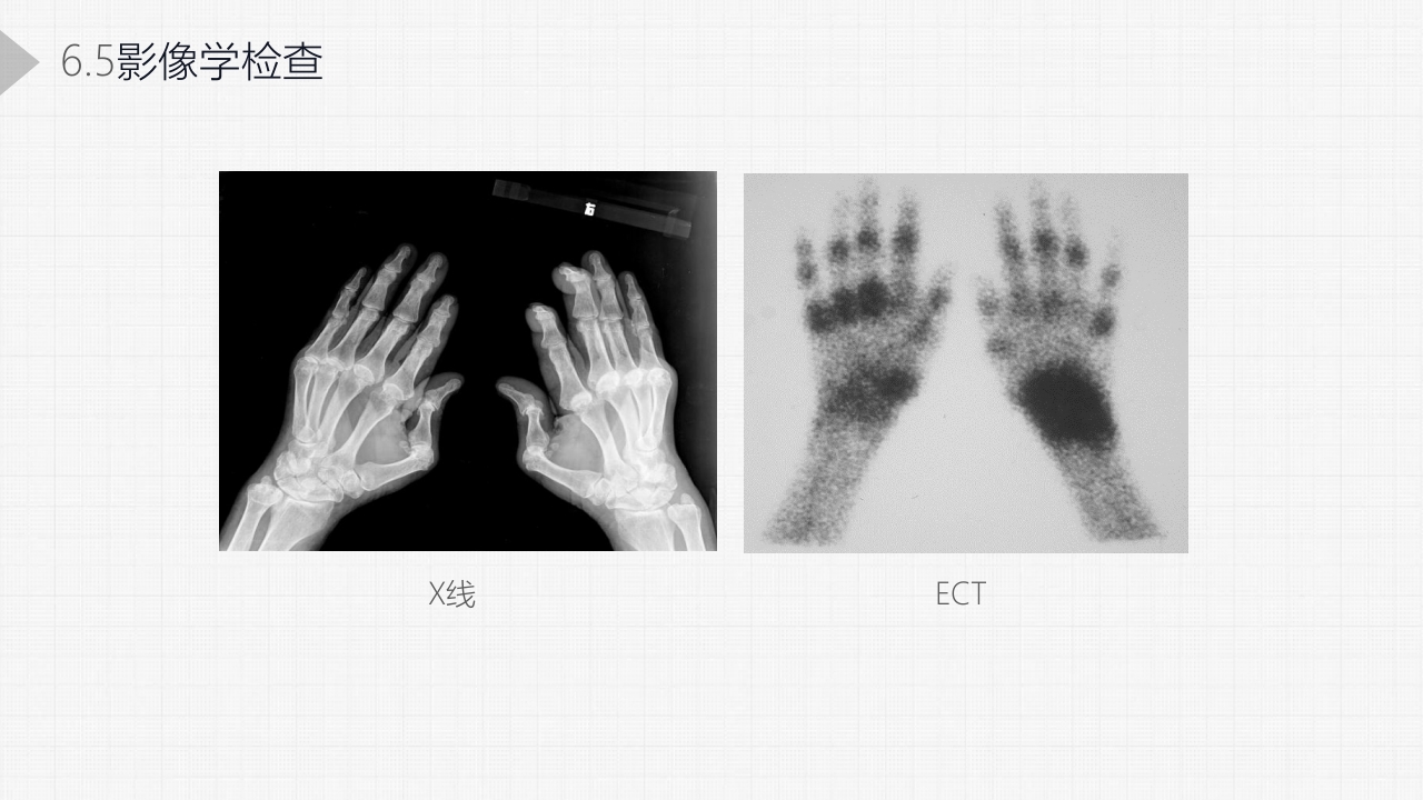 类风湿关节炎详细内容PPT课件25